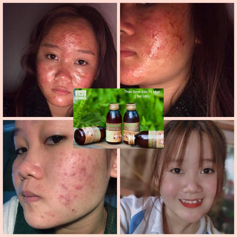 Tinh chất ngừa mụn trứng cá Lê Xuân 🍀Free ship☘️loại bỏ mụn đầu đen, mụn ẩn, mụn bọc,… | BigBuy360 - bigbuy360.vn