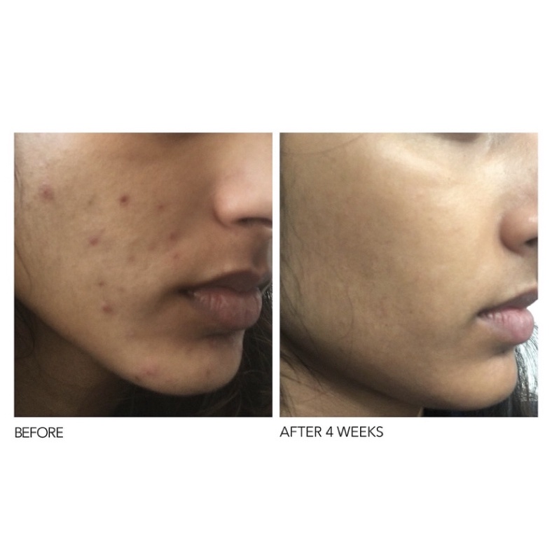 Tẩy tế bào chết Dr Dennis Gross Alpha Beta Extra Strength Daily Peel