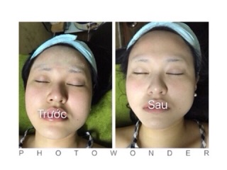 Cấy phấn MESO WHITE LẺ [ Có tách lẻ]