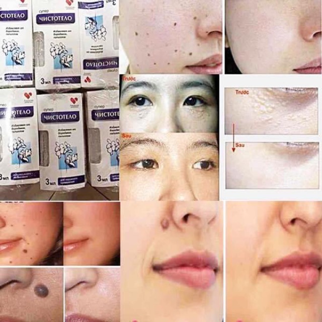 Gel tẩy nốt ruồi mụn cóc mụn cơm mụn thịt Dvedilin Nga