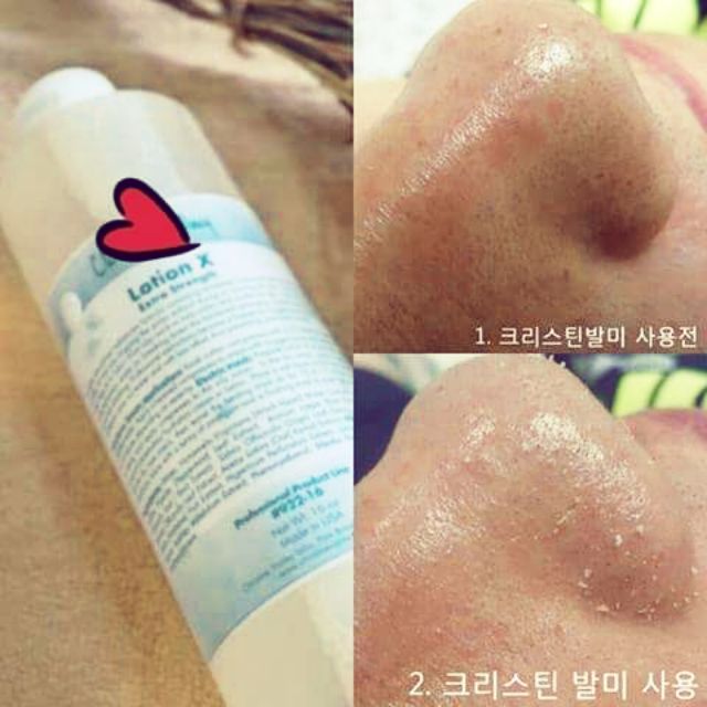 SIÊU Ủ MỤN CỦA MĨ SUPER X LOTION 1LÍT