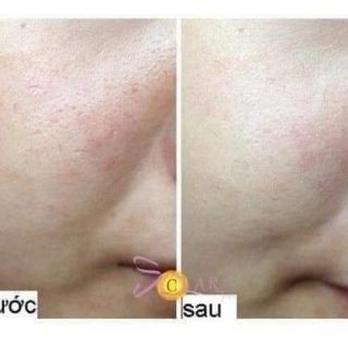 Mặt nạ Thải độc chì sủi bọt Bì Heo Bioaqua.