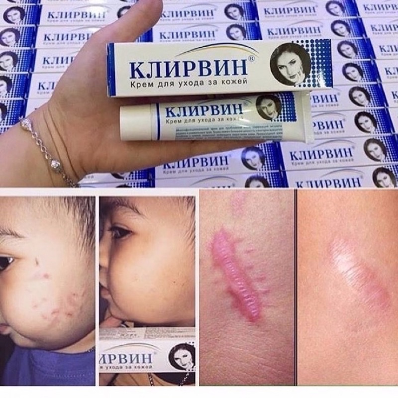 Kem mờ sẹo giảm thâm Klirvin Nga 25g (kem sẹo Nga)