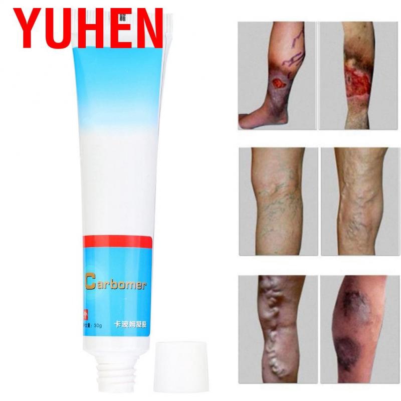 (hàng Mới Về) Thuốc Mỡ hỗ trợ giảm Giãn Tĩnh Mạch An Toàn Và Hiệu Quả