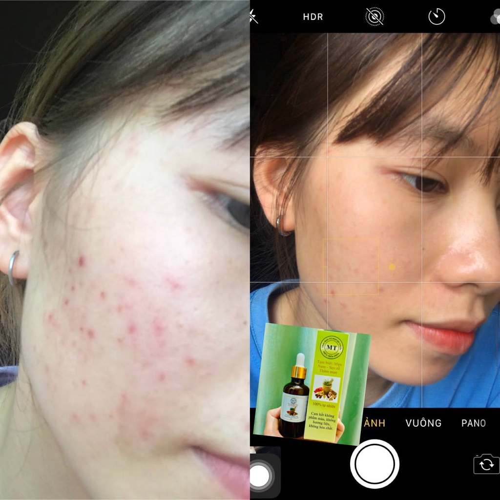 Thảo Dược Giảm Mụn Thâm Rỗ MT | BigBuy360 - bigbuy360.vn