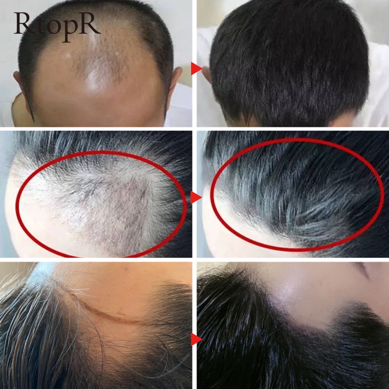 Tinh chất dưỡng tóc RtopR hỗ trợ kích thích mọc tóc ngăn rụng tóc và giúp mọc tóc phục hồi tóc hư tổn 20ml