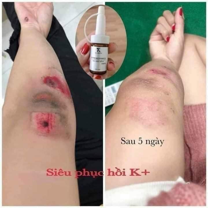 Serum siêu phục hồi da hư tổn trắng da, Xóa mờ các nếp nhăn, liền sẹo, làm đầy sẹo lõm  8ML - Super Reco Karmel