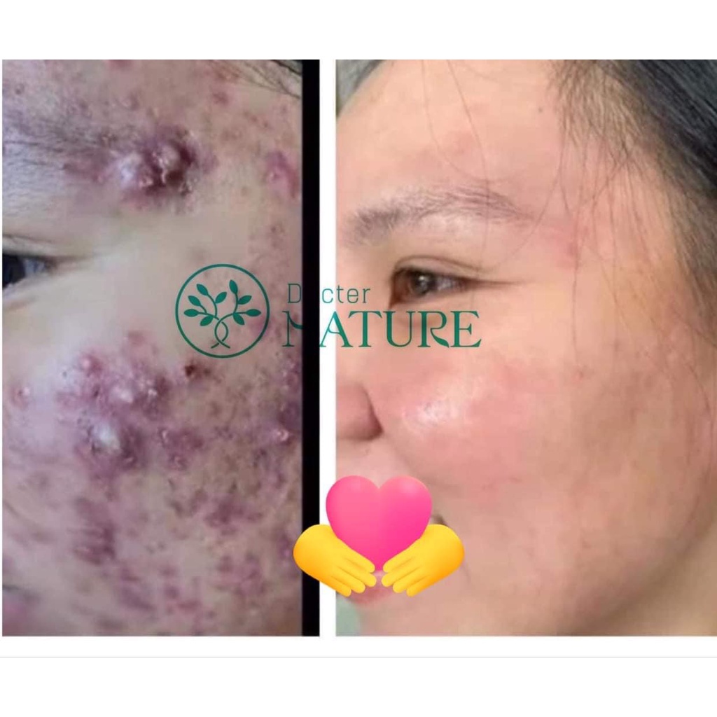 SERUM MỤN ACNES DOCTOR NATUR -