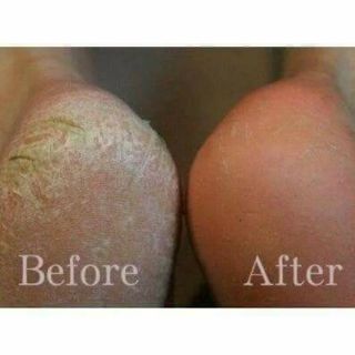 Kem chuối trị nứt gót chân thái lan