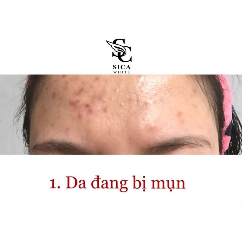 Face Mụn Sica | BigBuy360 - bigbuy360.vn