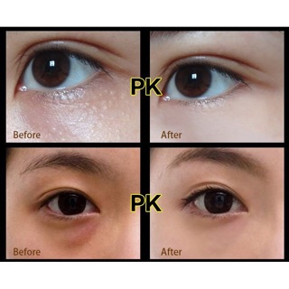 KEM MỤN THỊT GENTITAN EYE CREAM