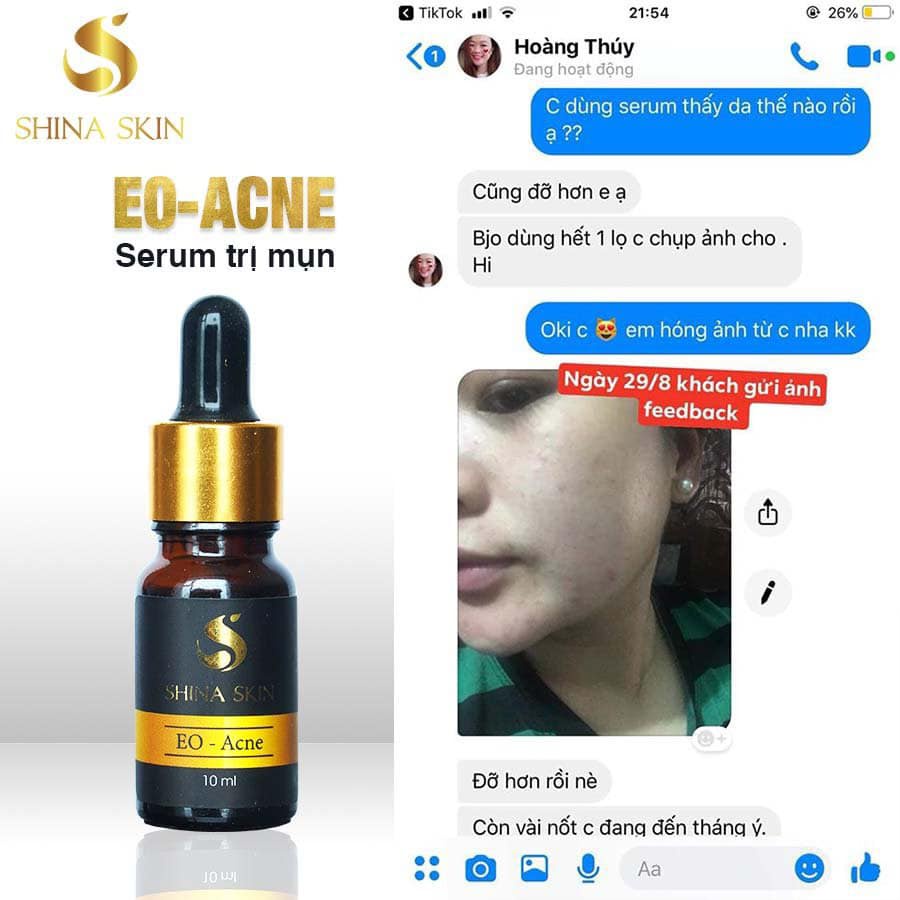 Sản Phẩm:Shina Skin EO-Acne