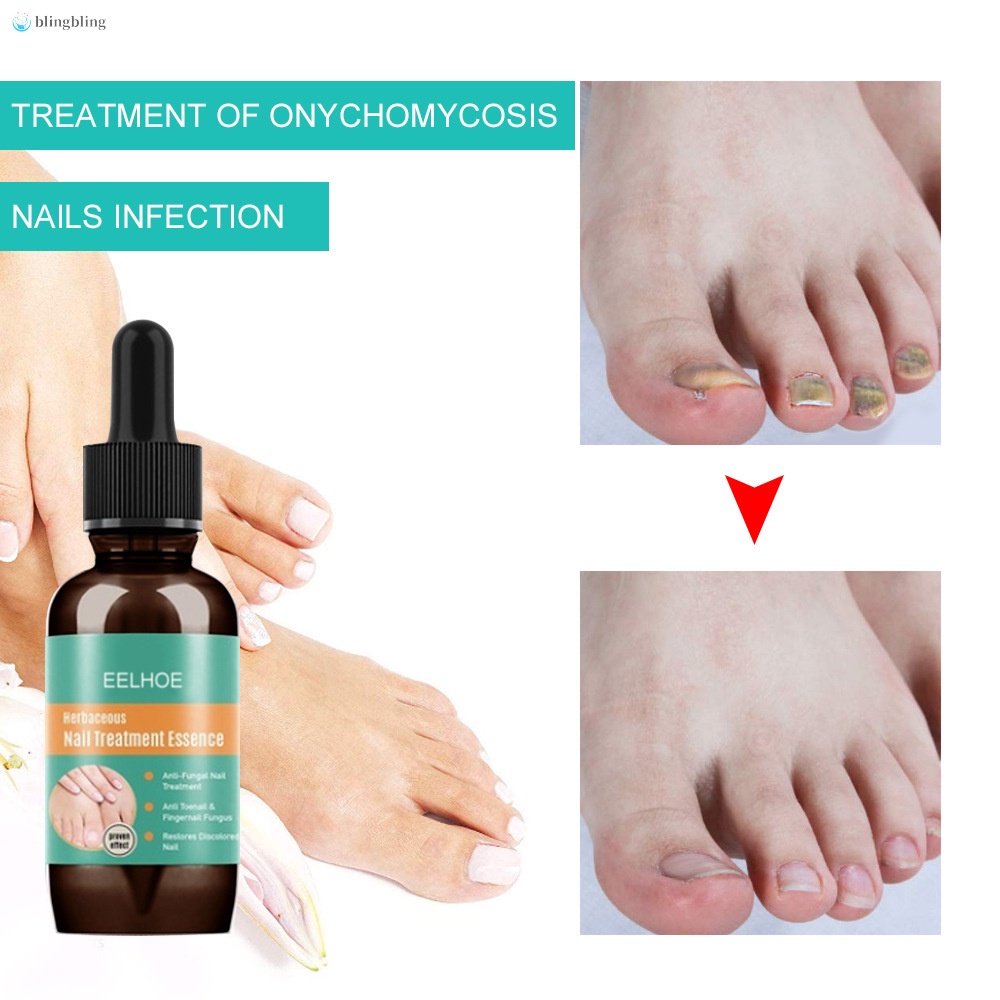 Tinh Chất Hỗ Trợ Giảm Bệnh Nấm Móng Tay Móng Chân Dung Tích 10ml 30ml