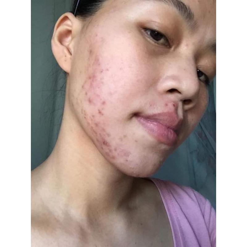 [SIZE 40ML] SERUM THANH DƯỢC - LÁRE THẢO DƯỢC ĐIỀU TRỊ DA | BigBuy360 - bigbuy360.vn