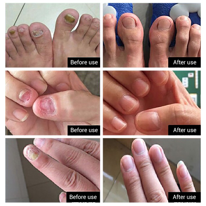 Serum Lanbena Phục Hồi Móng Tay Chân Chống Nấm - Nuôi Dưỡng Tái Tạo Móng EN