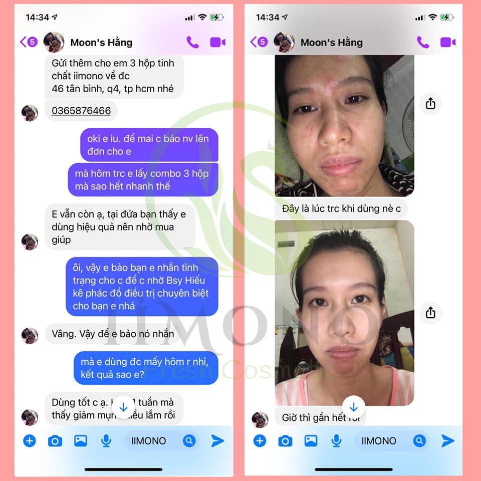 Giảm thâm mụn, bộ sản phẩm giảm mụn tinh chất thiên nhiên IIMONO | BigBuy360 - bigbuy360.vn