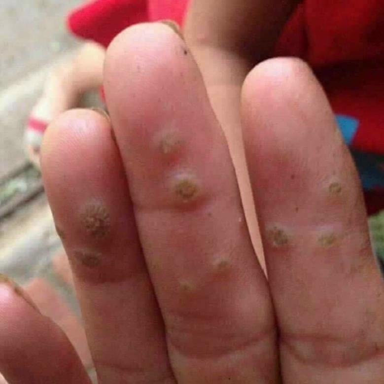 Gel tẩy nốt ruồi Nga