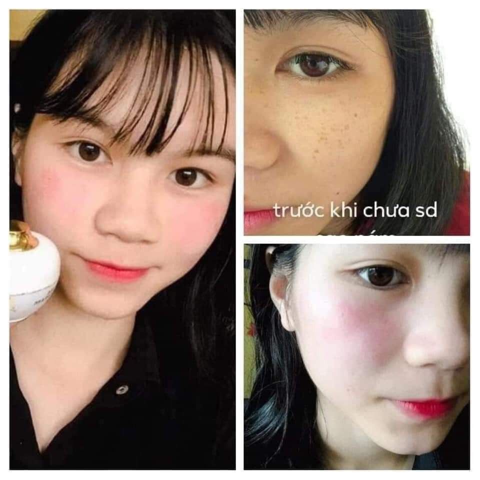 [Chính Hãng] Cao Nám Kem Ngừa Nám Tàn Nhang MagicSkin Royal Melasma Plus (size lớn) | BigBuy360 - bigbuy360.vn