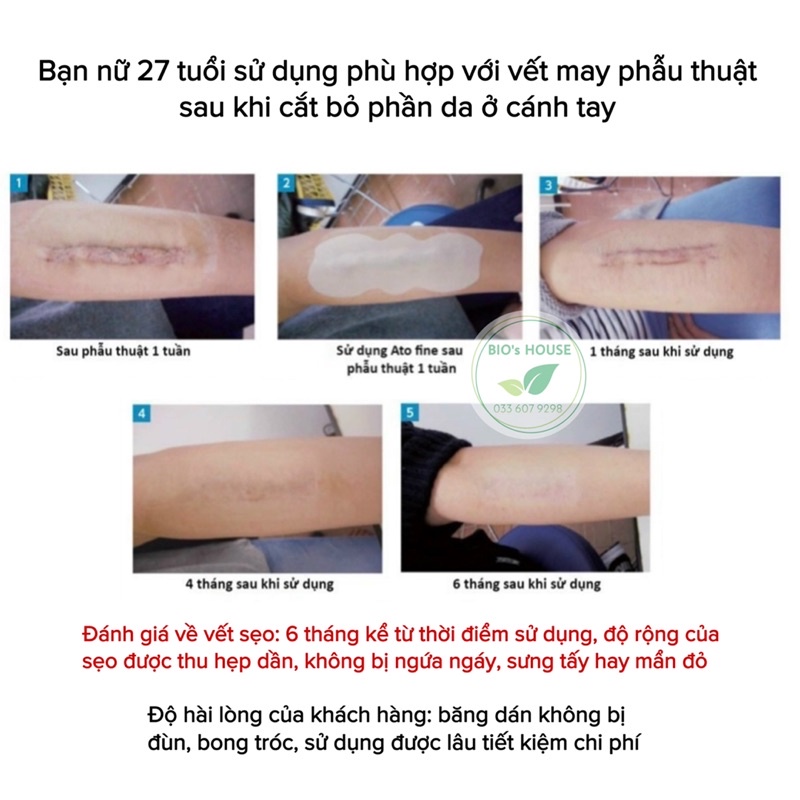Băng dán chống sẹo chuyên dụng, chăm sóc vết sẹo sau phẫu thuật, mổ đẻ