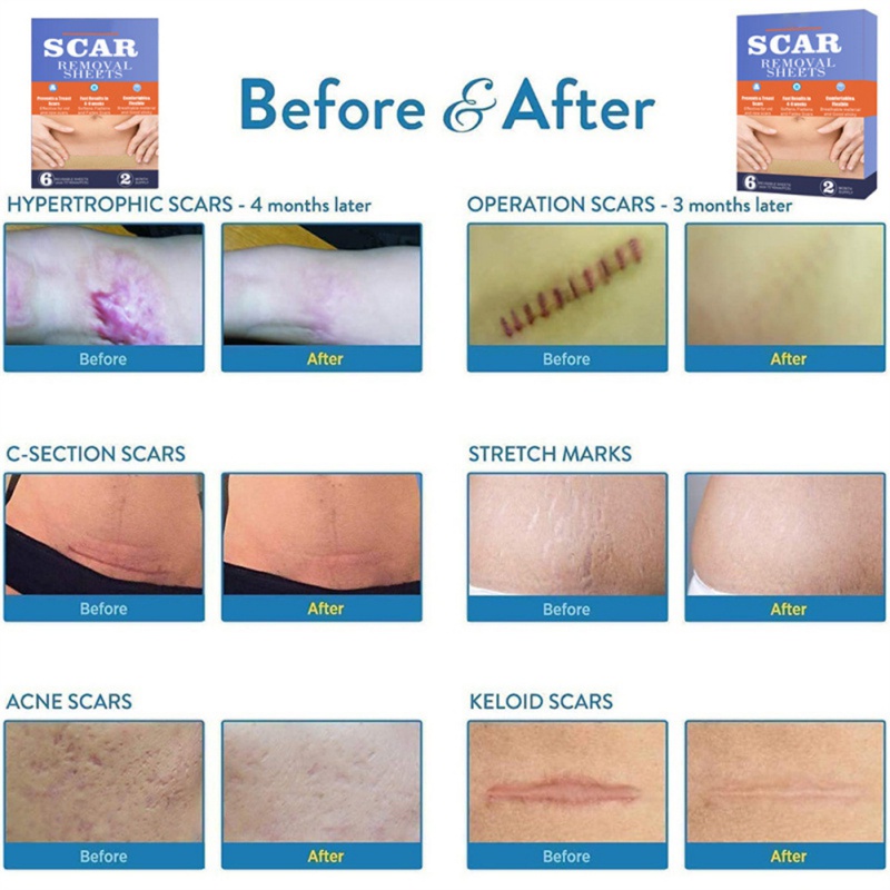 Hộp 6 Miếng Dán Sẹo Phẫu Thuật Kiểu Mới Tiện Dụng