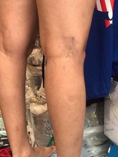 KEM TRỊ SUY GIÃN TĨNH MẠCH