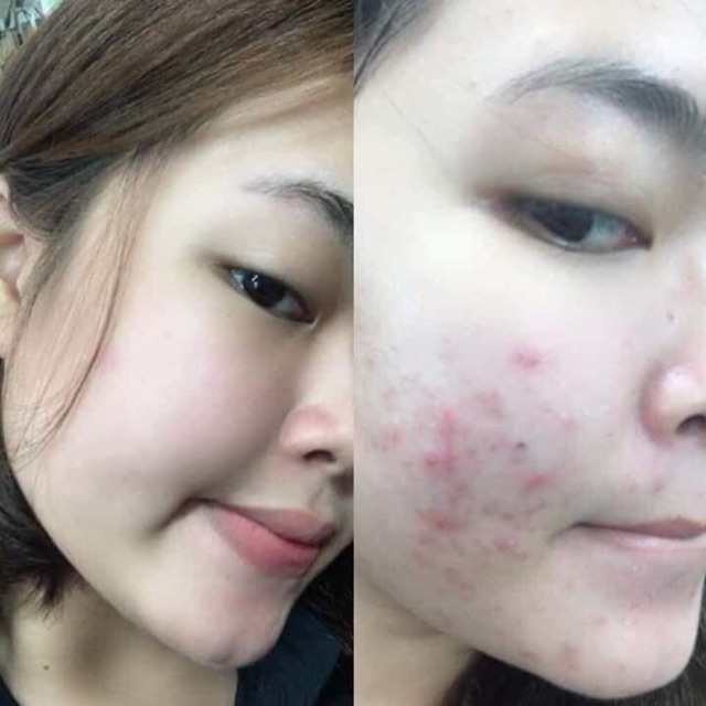 Kem giảm mụn Pair Acne 24g [ Chuẩn Nhật ]