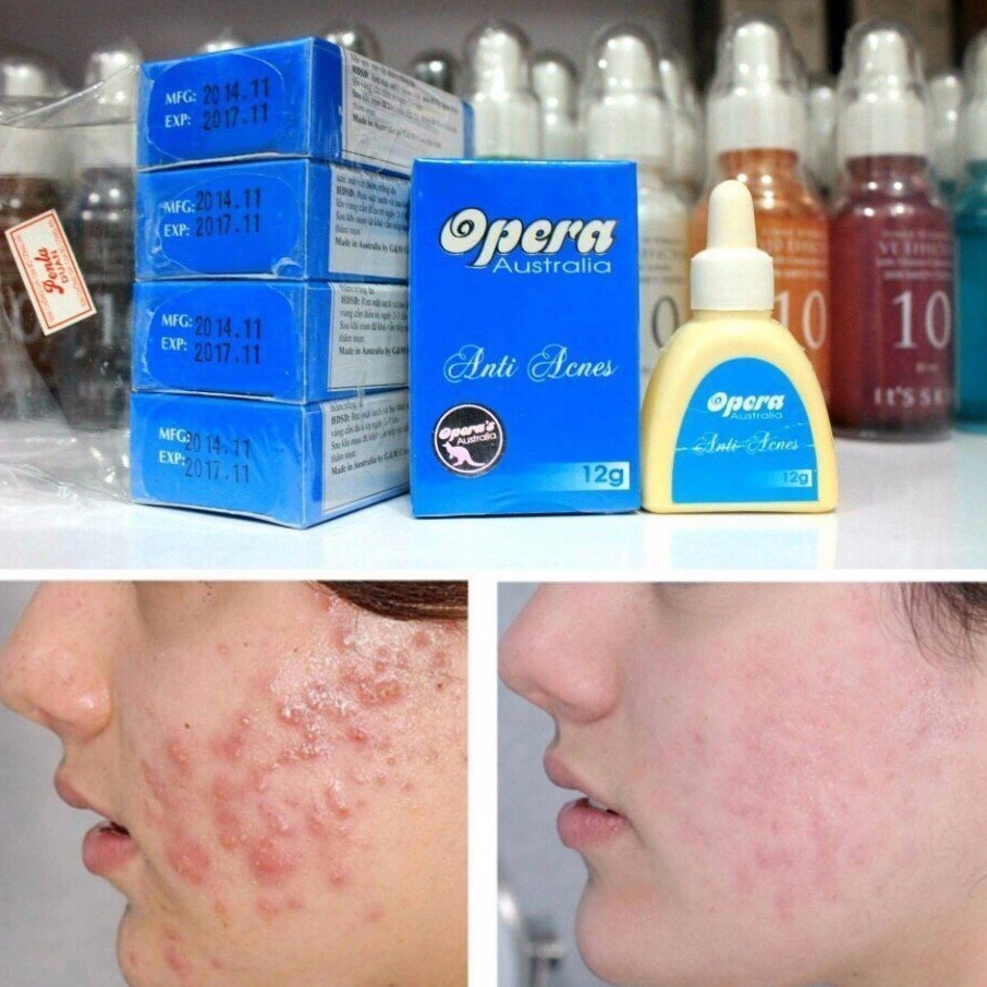 Kem Giảm Mụn Opera Australia Anti Acnes 12g (Hộp Xanh)