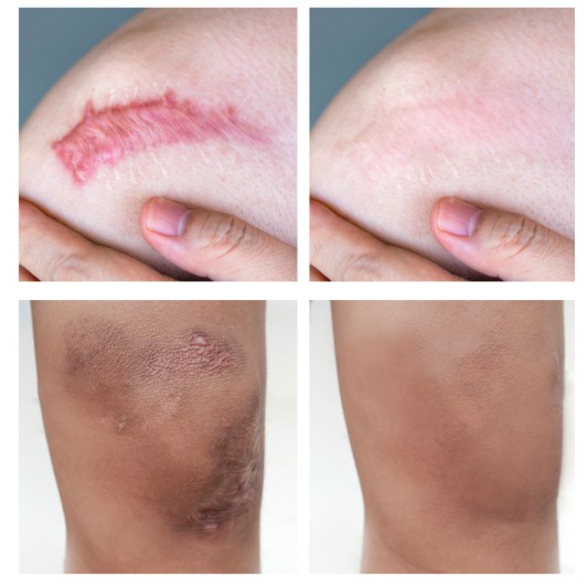 Kem Làm Mờ Sẹo Vibrant Glamour Treatment Gel VG