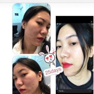 (💥CHÍNH HÃNG) Serum trị mụn Secret Life (hàng sẵn có).
