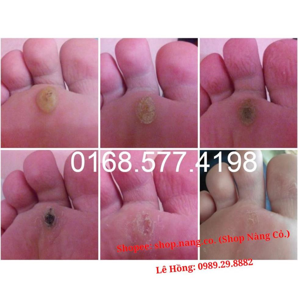 [Chính Hãng] Loại 3ml GEL TẨY NỐT RUỒI, MỤN CƠM, MỤN CÓC, SẸO LỒI, THỊT THỪA - Dvelinil nhập khẩu Nga Hiệu quả Tốt | BigBuy360 - bigbuy360.vn