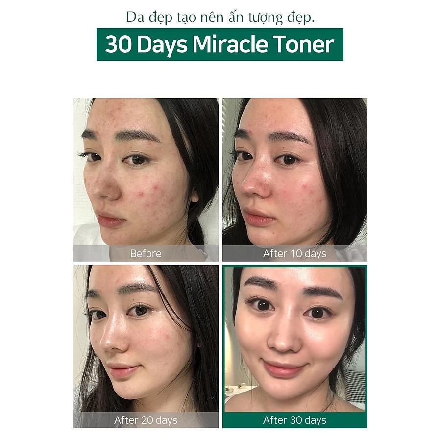 Nước Hoa Hồng Mụn AHA-BHA-PHA 30 days Miracle Toner Some By Mi