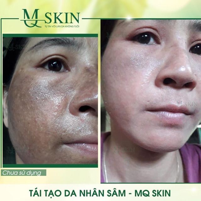 Serum tái tạo da nhân sâm MQskin ♥️Chính hãng♥️ Trị dứt điểm các vấn đề về da | BigBuy360 - bigbuy360.vn