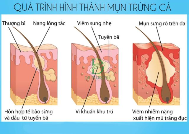 Tế bào gốc mụn  Dr Pluscell_ Cam kết hàng chính hãng | BigBuy360 - bigbuy360.vn