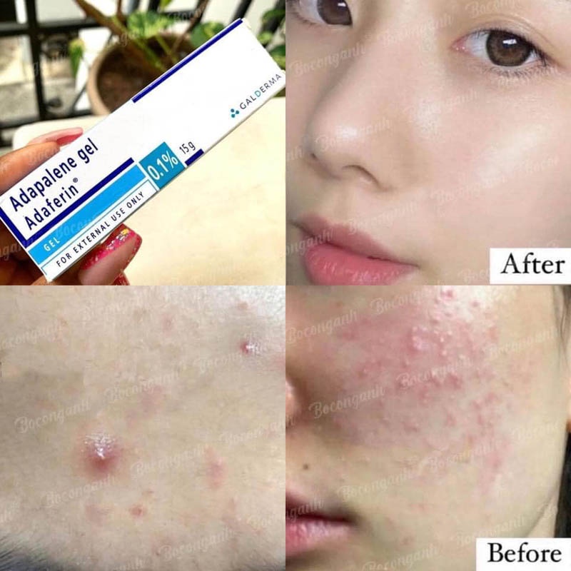 Kem Adapalene Gel 0.1 Adaferin Chính Hãng giúp giảm mụn ẩn mụn trứng cá mụn đầu đen hiệu quả 15g - YUPA.STORE