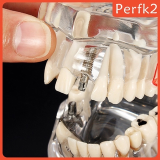 2x Human Mouth Dental Teeth Pathological Model Teaching Study Tools Clear