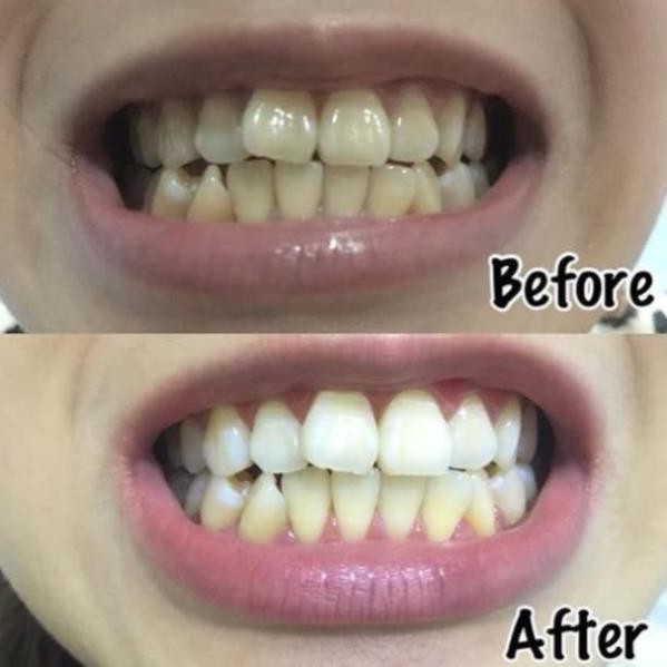 445566 Combo 14 miếng (7 gói/7 ngày) dán trắng răng Crest 3D White Whitestrips loại Professional Effects - Mỹ