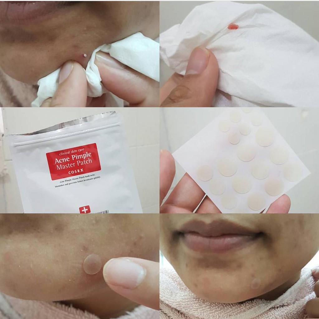 Miếng Dán Mụn Cosrx Acne Pimple Master Patch 24 Miếng Màu Đỏ | Hút Mụn Clear Fit Master Patch 18 Miếng Màu Đen