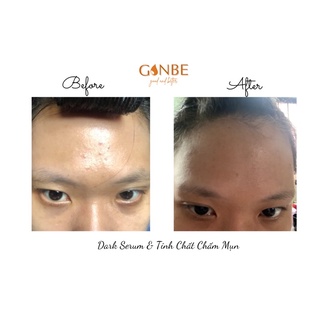 TINH CHẤT CHẤM MỤN