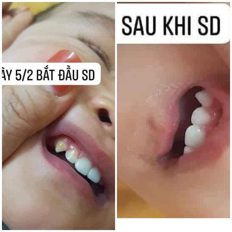 VECNI FLOUR  phòng ngừa sâu sún răng cho bé