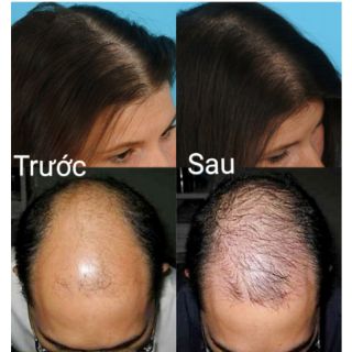 DẦU GỘI KÍCH THÍCH MỌC TÓC NHẬT BẢN