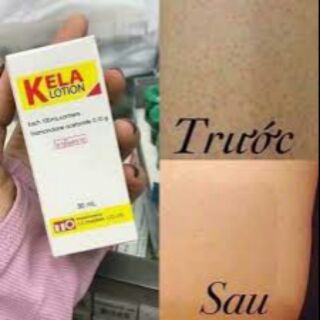 KELA LOTION (trị viêm lỗ chân lông Thái Lan)