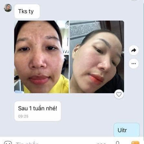 Peel White Tái Tạo Da Trắng Khỏe - Ngăn Ngừa Mụn Nám Thanh Nhi - Nicos