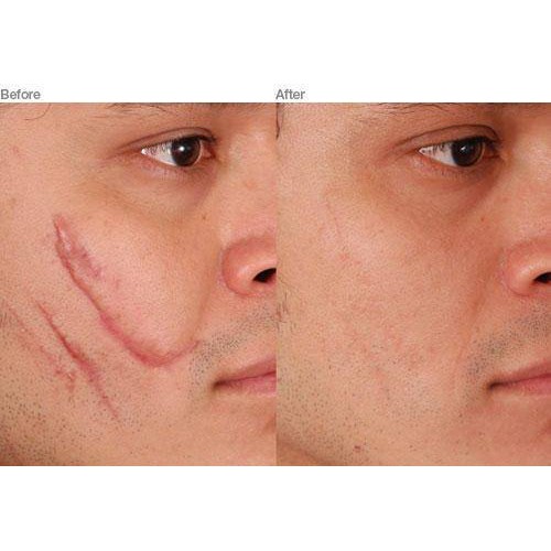 Gel Mờ Sẹo Lồi Rejuvasil 10ml | BigBuy360 - bigbuy360.vn