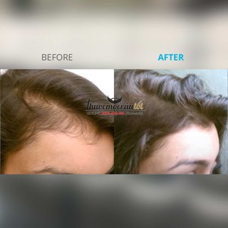 Thuốc mọc tóc Minoxidil 5% cho Nữ