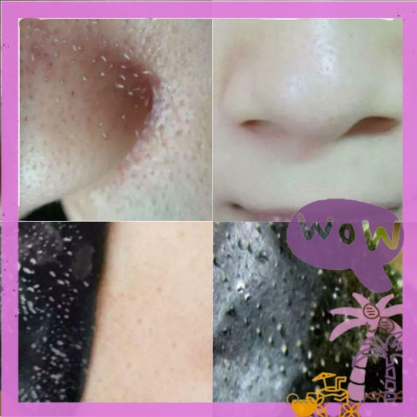 GÓI LỘT MỤN ĐẦU ĐEN MỤN ẨN nếp nhăn căng da dưỡng ẩm trắng hồng mềm mịn nội địa skincare mask sỉ tốt NGỰA BEAUTY | BigBuy360 - bigbuy360.vn
