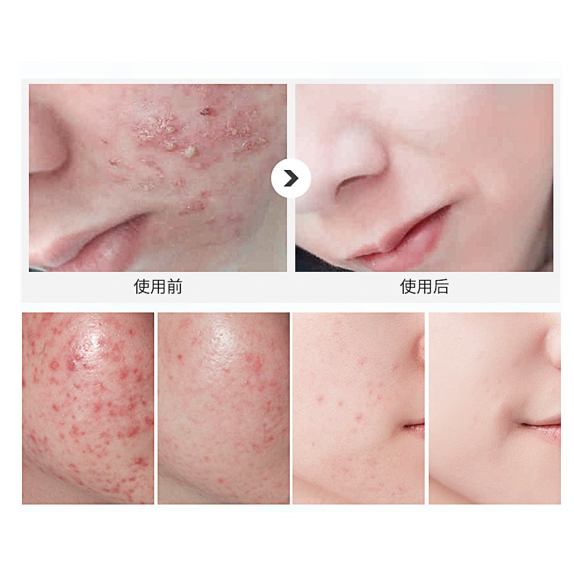 Kem giảm mụn trứng cá hiệu quả, làm sạch da loại bỏ tế bào xấu - T444 | BigBuy360 - bigbuy360.vn