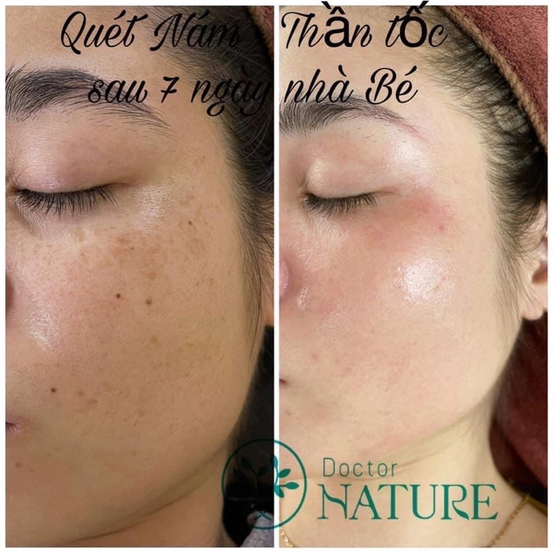 QUÉT NÁM  DR.Nature Peel skin Diamond(tái tạo trẻ hoá da,sáng căng bóng,mờ thâm nám xạm,nhỏ lcl,dùng mọi loại da,...