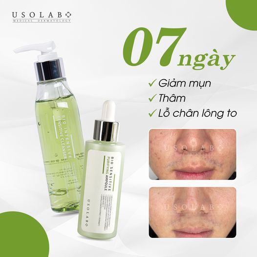 Sữa rửa mặt da dầu mụn, lỗ chân lông to 150ml Usolab Bio Intensive Sensitive Cleanser