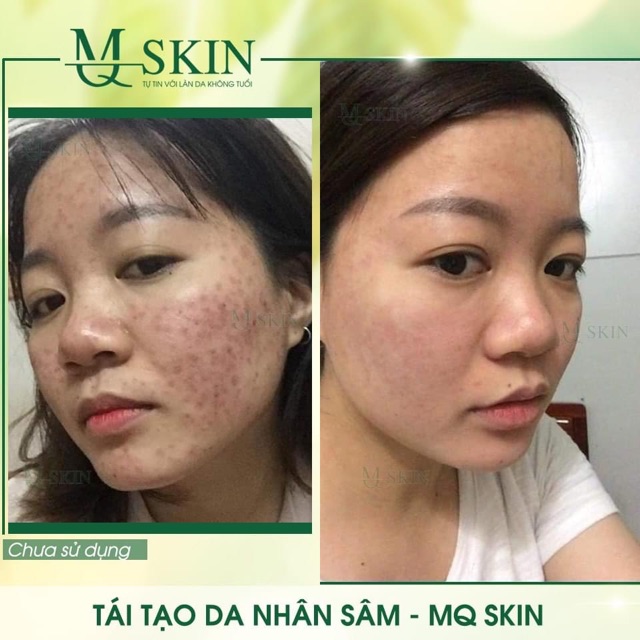 Serum tái tạo da nhân sâm MQskin ♥️Chính hãng♥️ Trị dứt điểm các vấn đề về da | BigBuy360 - bigbuy360.vn