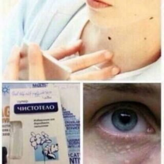 GEO TÂYE NỐT RUỒI ,MỤN CƠM ,MỤN CÓC ,THỊT THỪA